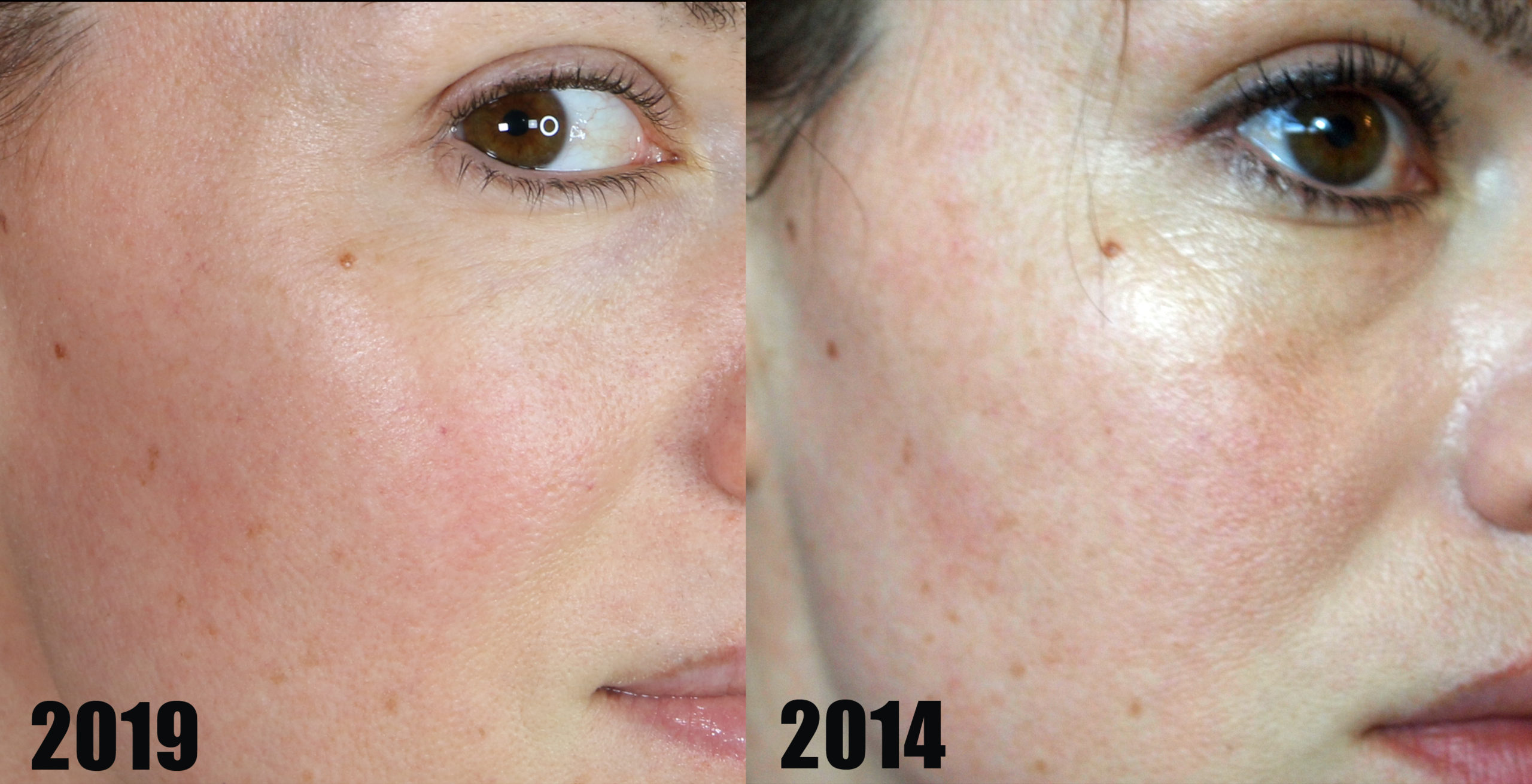 Real Results 5 Yrs of Face Peels Life and DIY