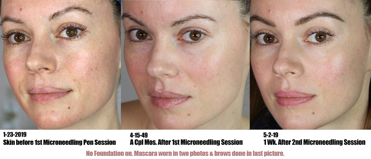 Microneedling Before & After 