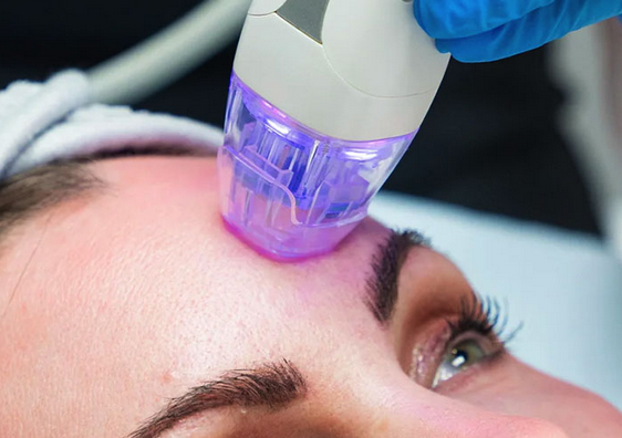 RF Microneedling RF Microneedling