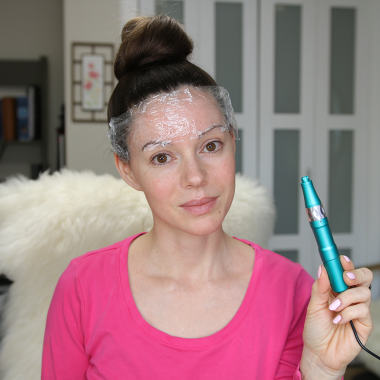 Microneedling Before and Afters – 8 Treatments (16 Mos.)
