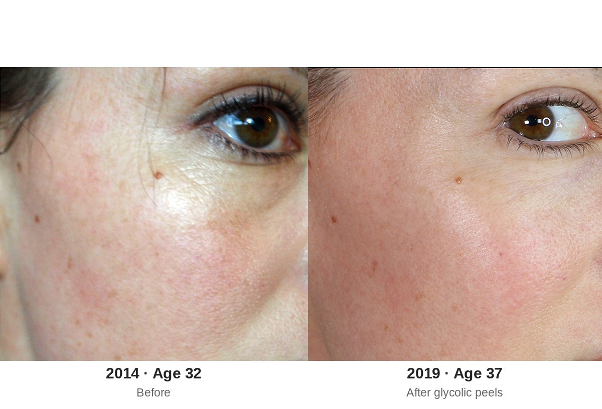 Glycolic peel before and after, close-up of under-eye skin and sunspots in 2014 at age 32 and 2019 at age 37
