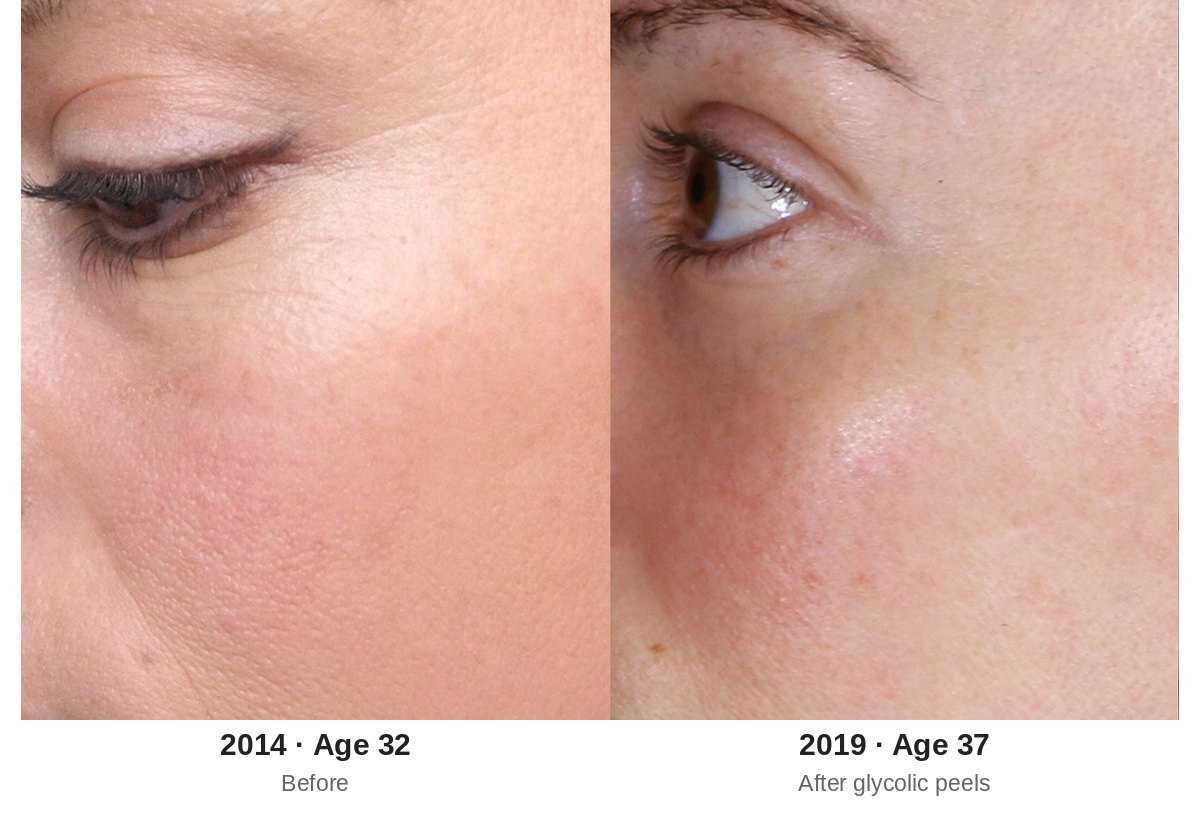 Glycolic peel before and after, close-up of lines at the side of the eye in 2014 compared to 2019