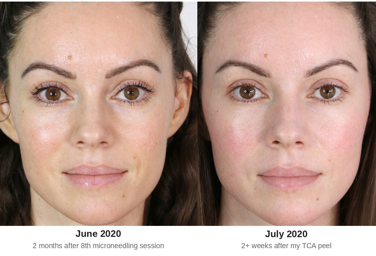 TCA peel before and after, face two months after 8 microneedling sessions compared to two weeks after a TCA peel in July 2020