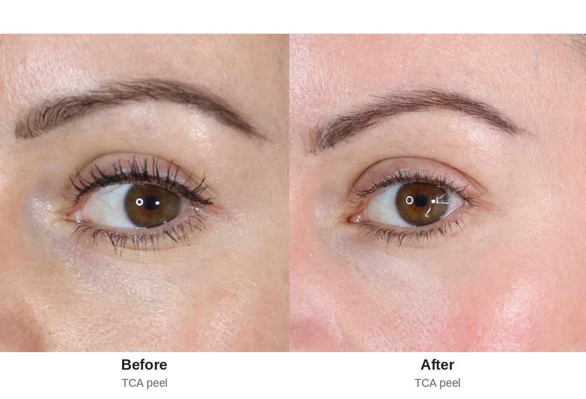 TCA peel before and after, close-up of under-eye lines and skin texture