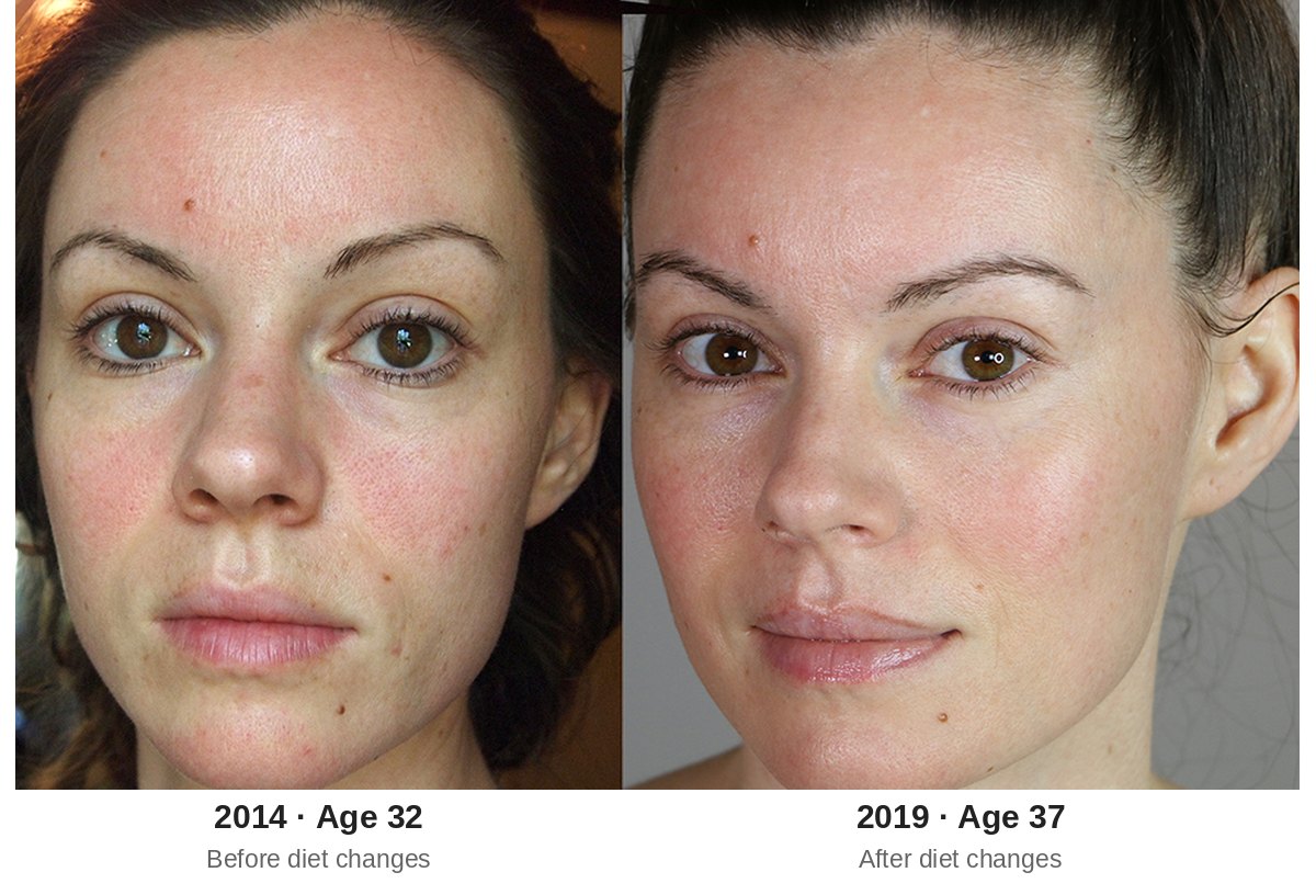 Before and after diet changes, facial puffiness and redness in 2014 at age 32 compared to 2019 at age 37